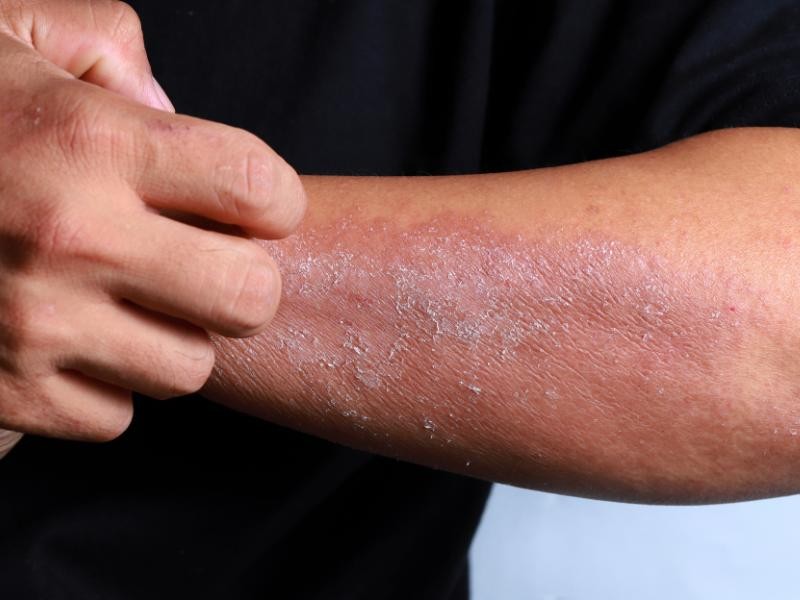 Quais Doenças de Pele Podem ser Diagnosticadas com uma Biópsia Dermatológica?