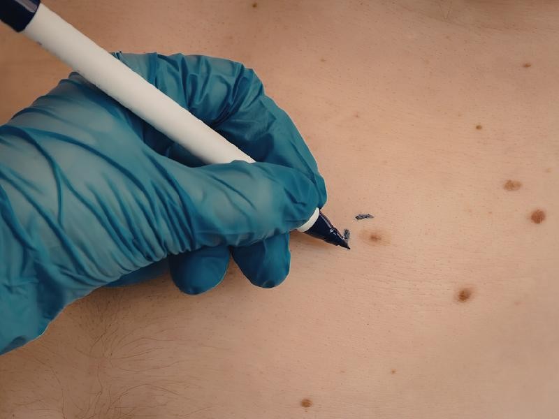 Quando devo Fazer uma Biópsia Dermatológica para Lesões de Pele?